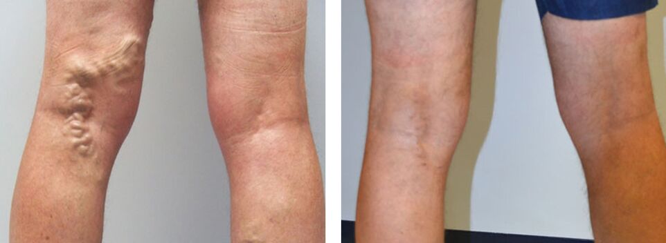 Foto prima e dopo l'utilizzo di Veniselle, esperienza nell'uso della crema
