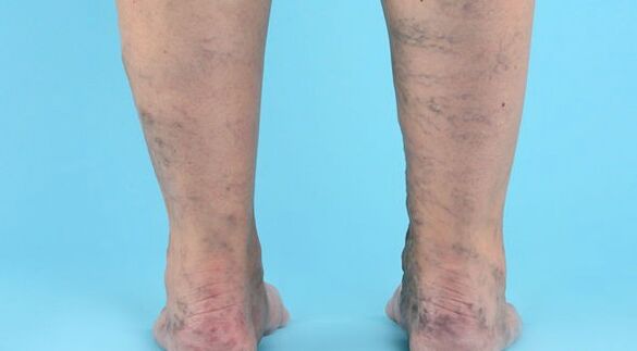 Malattia varicosa