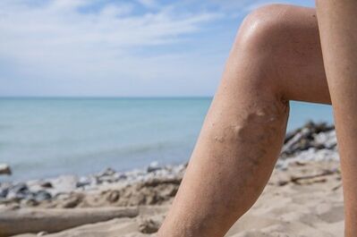 Vene varicose sulle gambe