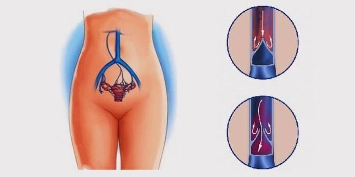 Vene varicose del bacino