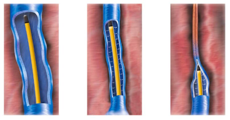 ablazione con radiofrequenza come metodo di trattamento delle vene varicose