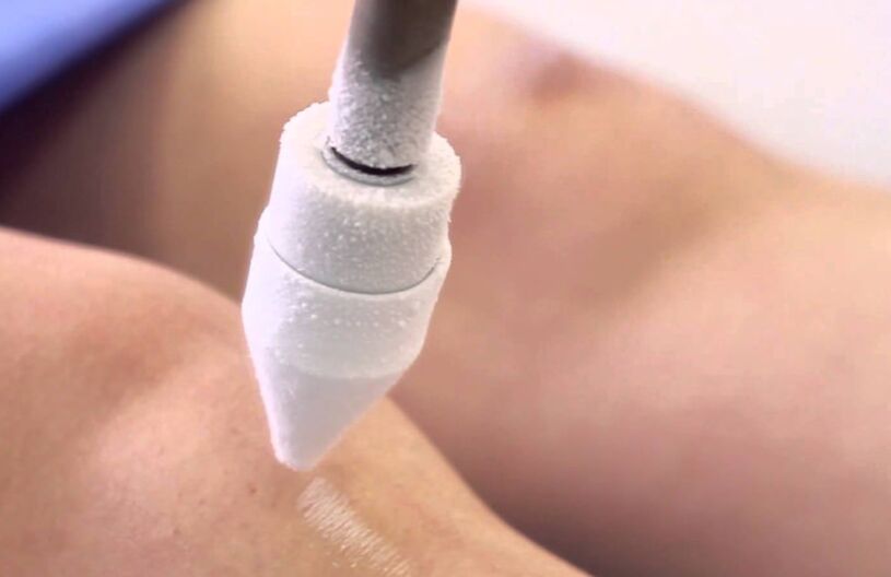 trattamento delle vene varicose sulle gambe con crioterapia