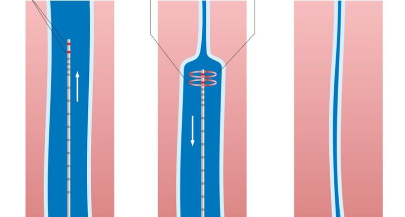 trattamento laser per vene varicose sulle gambe